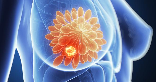 Organic Argan Oil for Breast Cancer Radiation