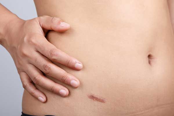 Argan Oil Skin Care For Scar Care